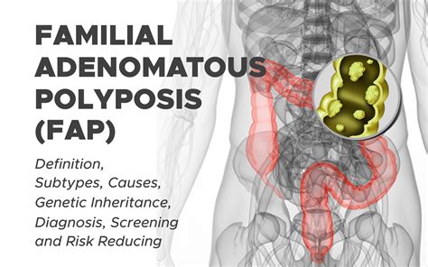 Familial adenomatous polyposis .